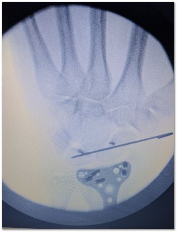 titanium volar distal radius plate, fractured wrist