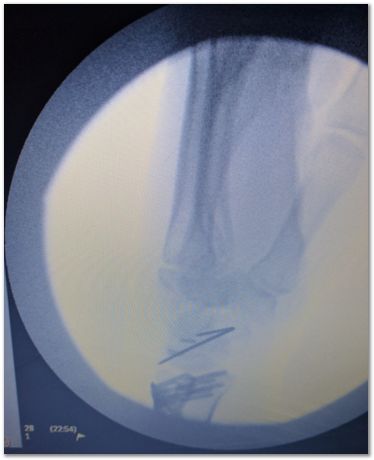 titanium volar distal radius plate, fractured wrist