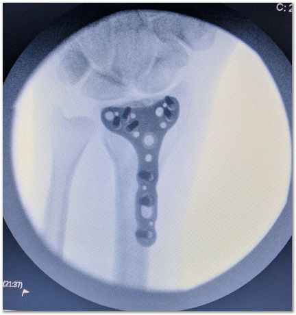 titanium volar distal radius plate, fractured wrist