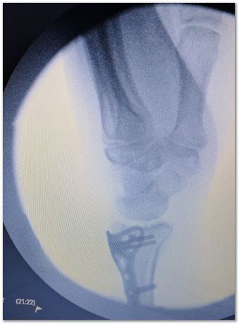 titanium volar distal radius plate, fractured wrist